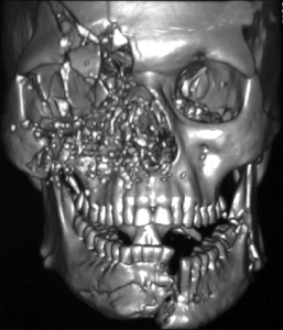CBCT: A Revolution in Oral and Maxillofacial Surgery Imaging