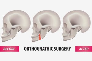 Orthognathic Surgery: 