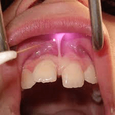 THE ROLE OF DENTAL SOFT TISSUE LASER IN TREATING VARIOUS DENTAL CONDITIONS