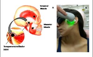 The Advanced Low Level Laser Therapy For Treating TMJ Disorders