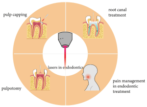 Lasers In Endodontic