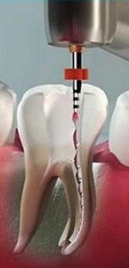 Top 5 Factors to Know in Rotary Endodontics to Minimize RCT Failure