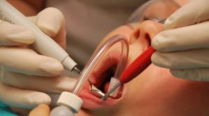 ultrasonic-teeth
